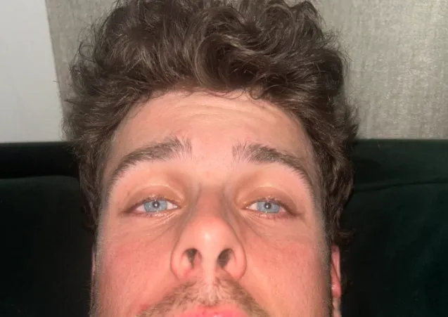 Picture of Blue Jays Ernie Clement face after taking fastball to the face #bluejays #mlb