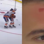 Tony DeAngelo struck in the head by a puck before Islanders game in Ottawa